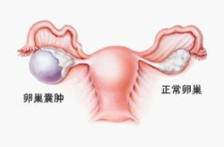 卵巢囊肿症状,了解身体发出的健康信号