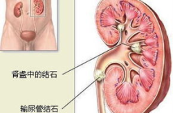肾结石的食疗方法,天然养生，呵护肾脏健康